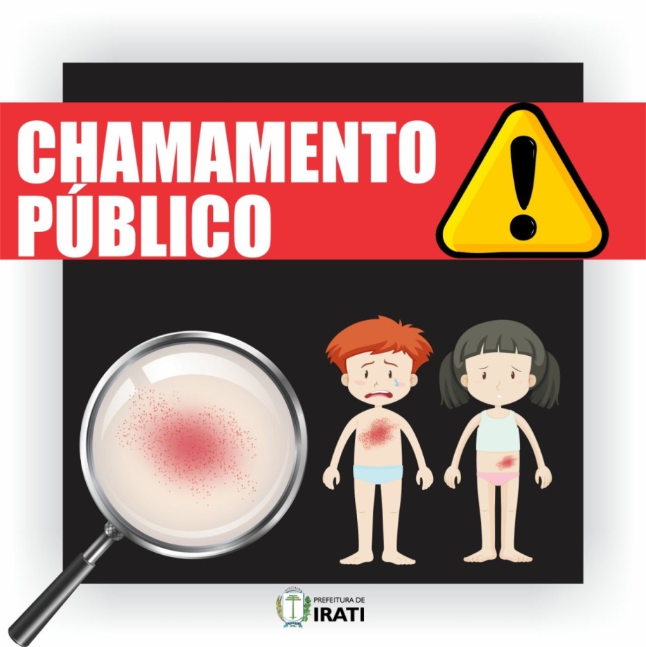 Chamamento Público por nova suspeita de sarampo em Irati